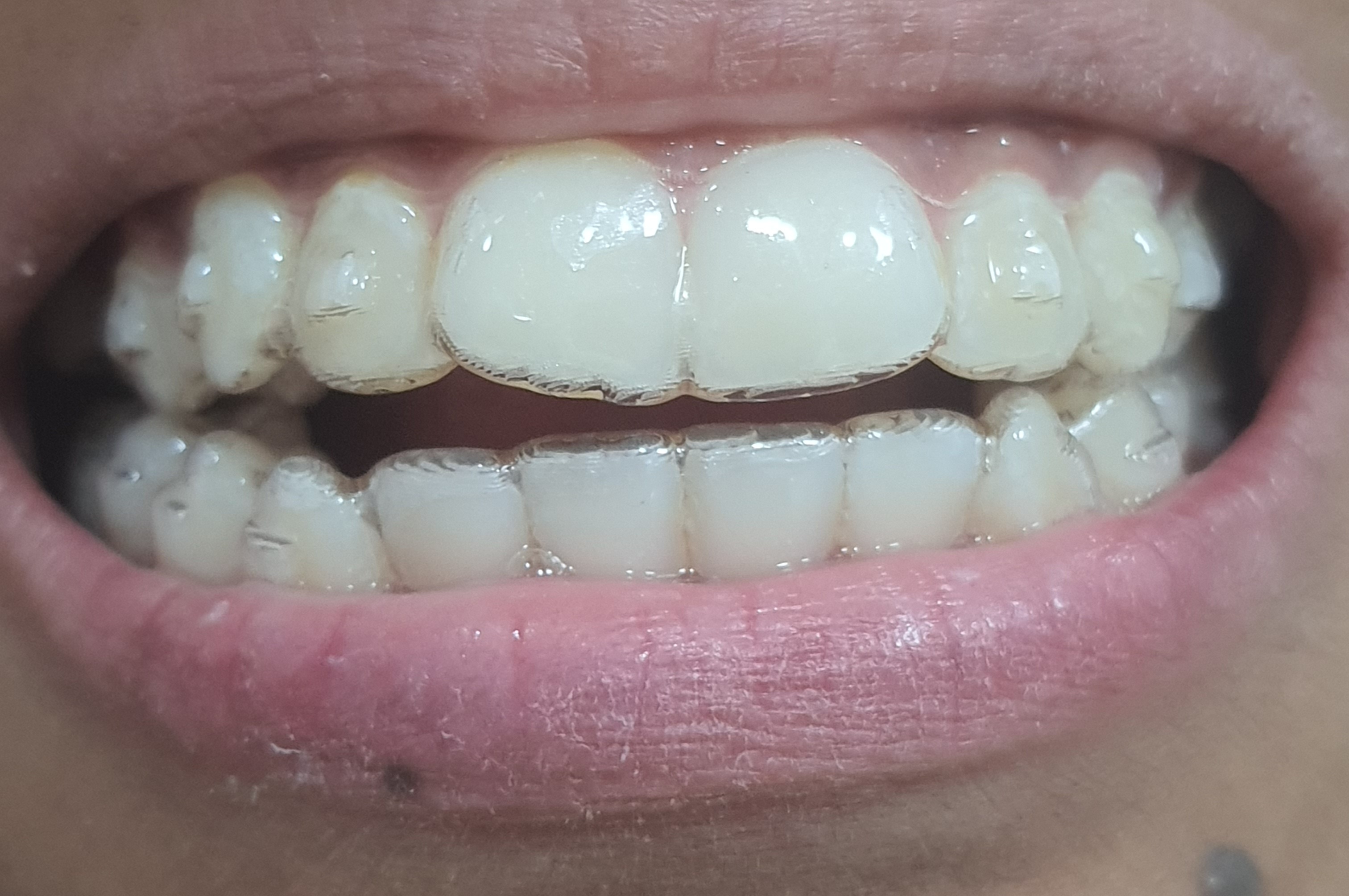 Invisalign clear aligner in greater noida